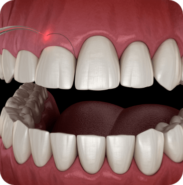 graphic of a Gingivectomy surgey