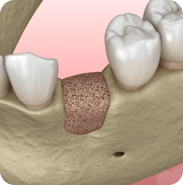 graphic of a bone grafting